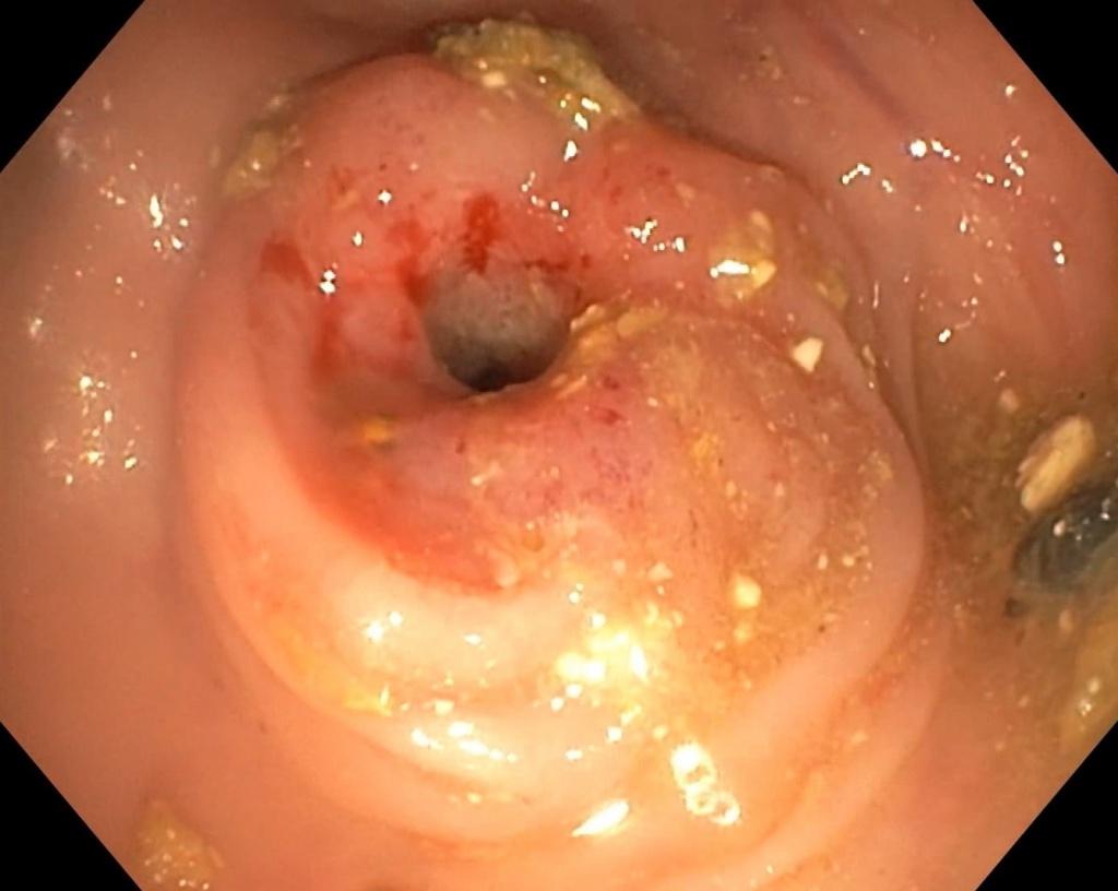 Стенозирующая циркулярная опухоль поперечной ободочной кишки. Атлас эндоскопических изображений endoatlas