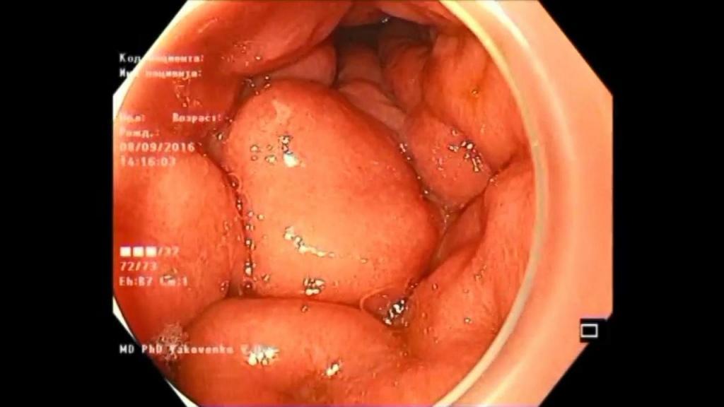 Linitis plastica Пластический линит. Атлас эндоскопических изображений endoatlas