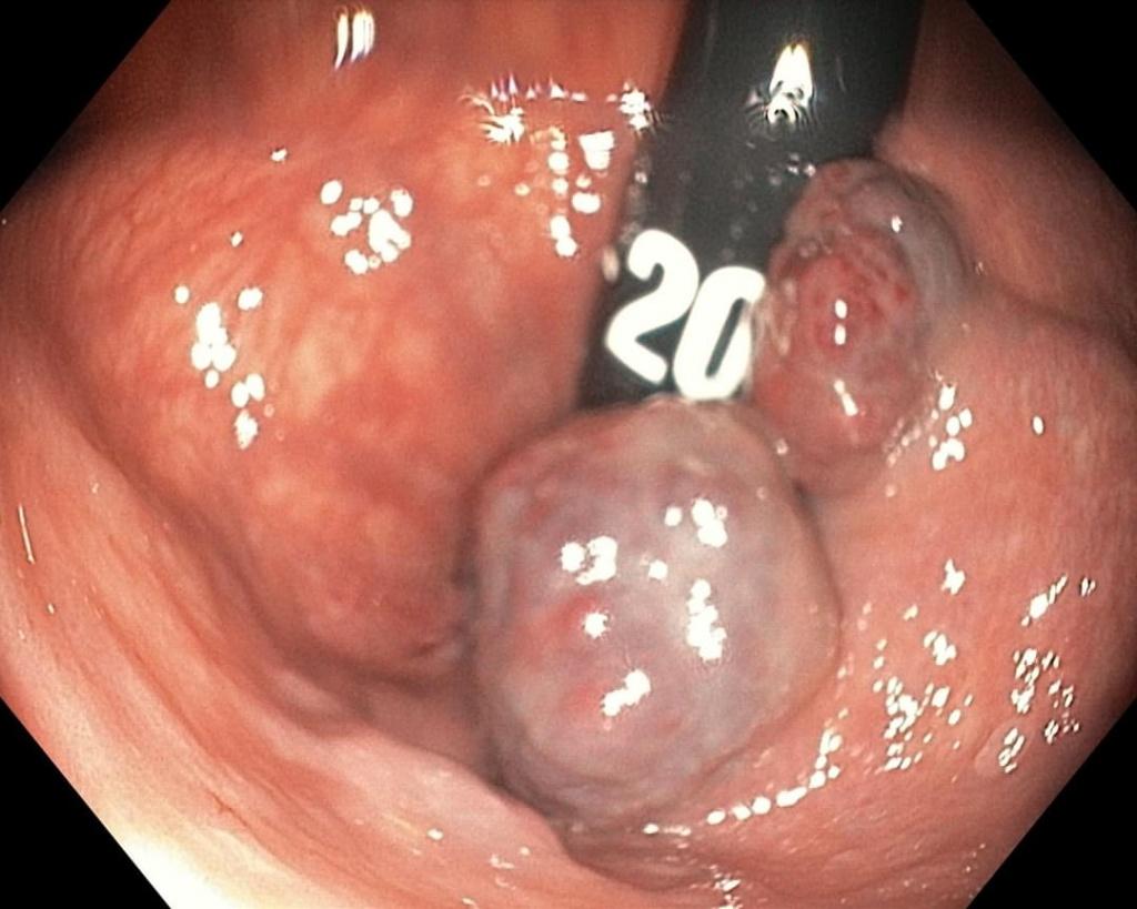 Необычные полипы прямой кишки.. Атлас эндоскопических изображений endoatlas