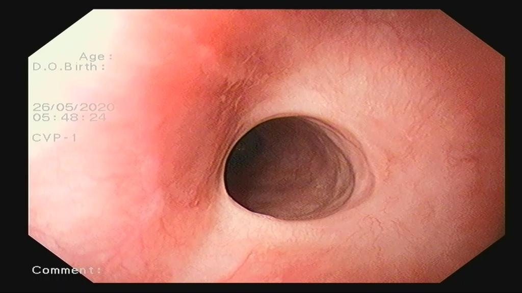 Рубцовая деформация просвета пищевода. Атлас эндоскопических изображений endoatlas