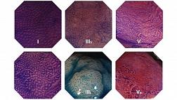 Классификация KUDO с применением увеличительной хромоэндоскопии для эпителиальных новообразований толстой кишки