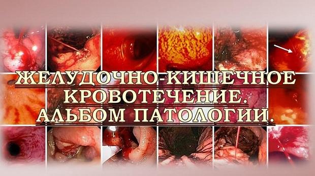 Эндоскопия при кровотечениях желудочно кишечного тракта