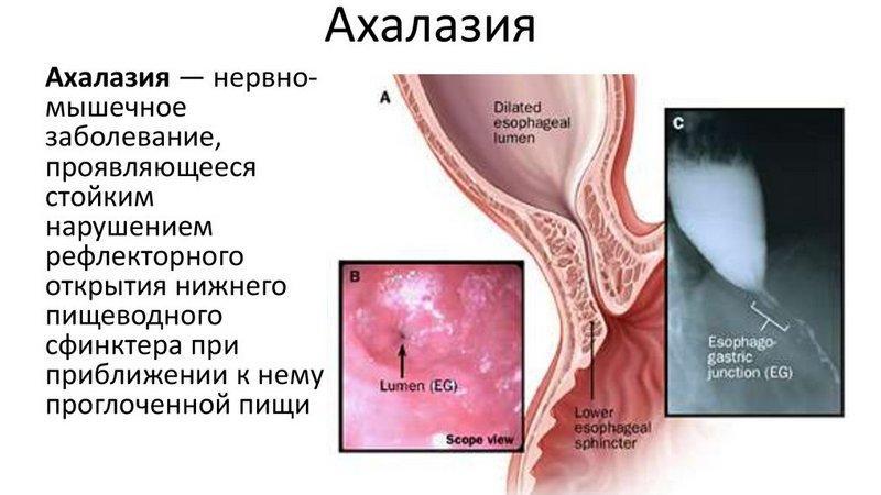 Установка стена при раке пищевода