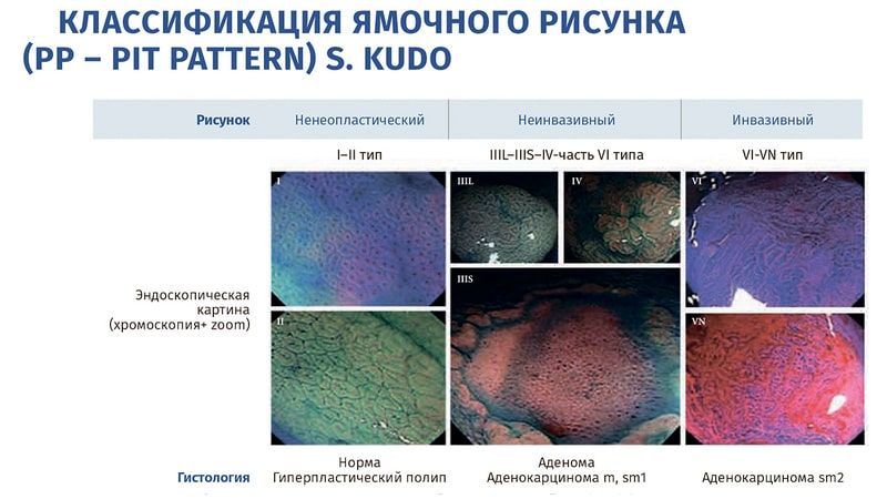 Классификация сосудистого рисунка классификация sano