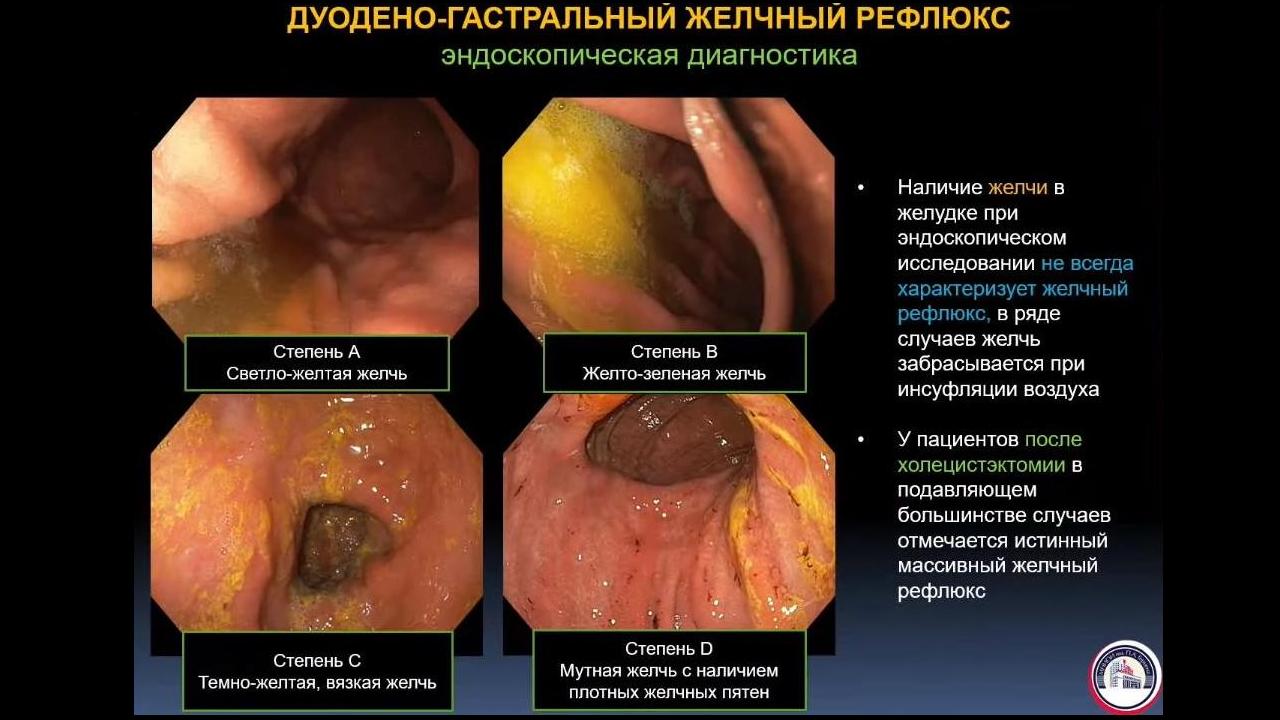 «Горло будто сжимают изнутри»: как операция на желудке помогла мне справиться с удушьем