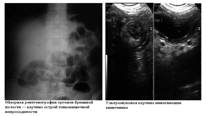 Острая тонкокишечная непроходимость код мкб 10 thumbnail