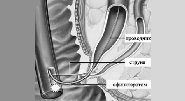 Эндоскопическая папиллосфинктеротомия презентация