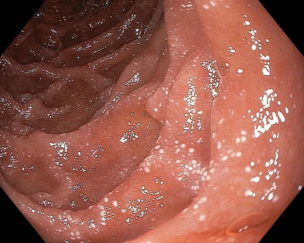 Лимфангиоэктазии D2 (нисходящий отдел 12ПК).. Атлас эндоскопических изображений endoatlas