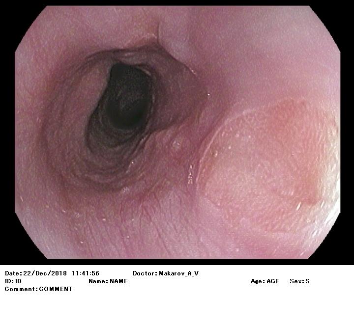 Гетеротопия (эктопия) желудочного эпителия в пищевод. Атлас эндоскопических изображений endoatlas