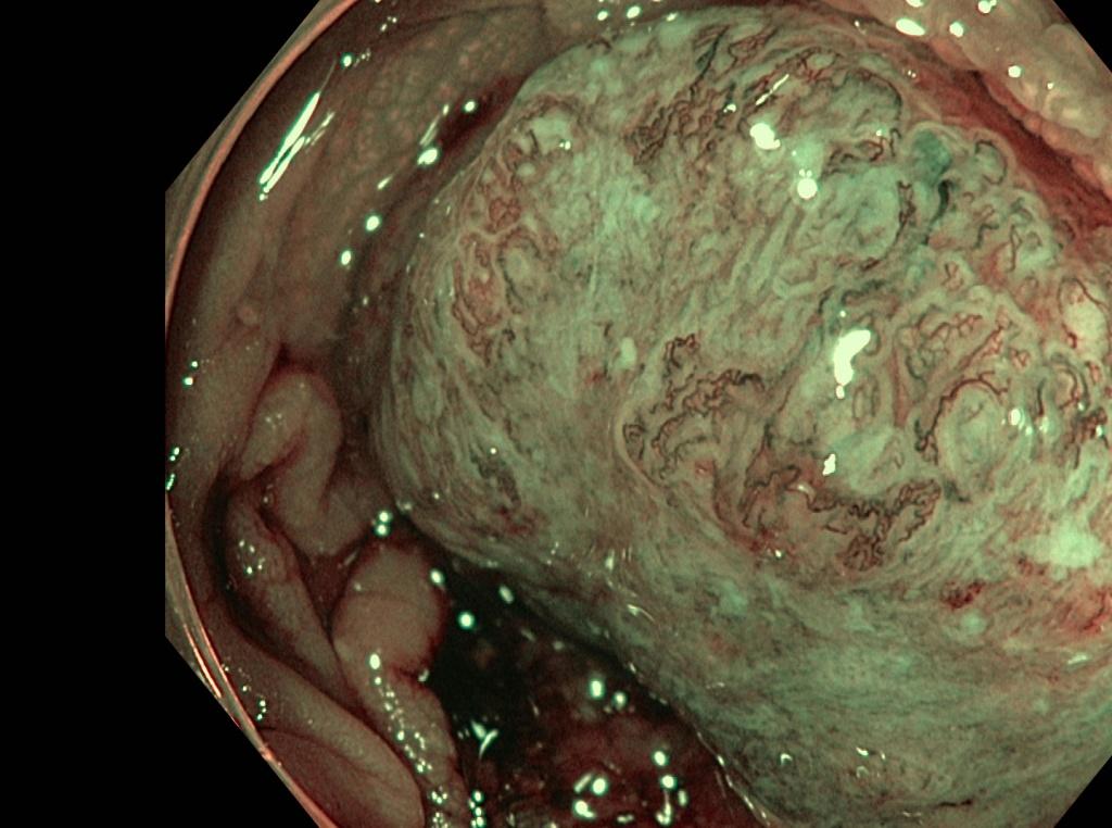 Инвазивная аденокарцинома сигмовидной кишки.. Атлас эндоскопических изображений endoatlas
