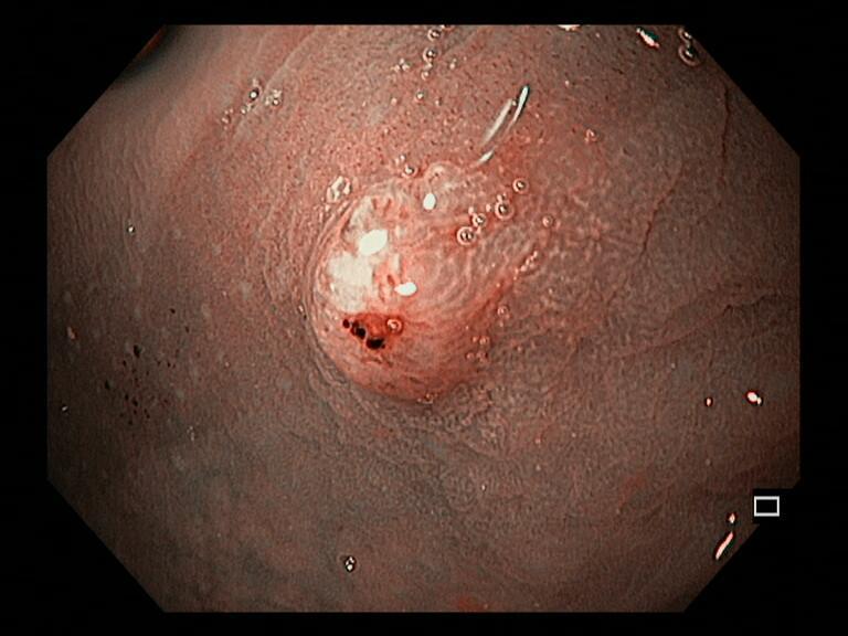 Аденокарцинома in situ прямой кишки.jpg. Атлас эндоскопических изображений endoatlas