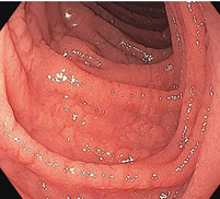 Целиакия ( cетчатый рисунок  слизистой  в ДПК, осмотр в WLI). Атлас эндоскопических изображений endoatlas