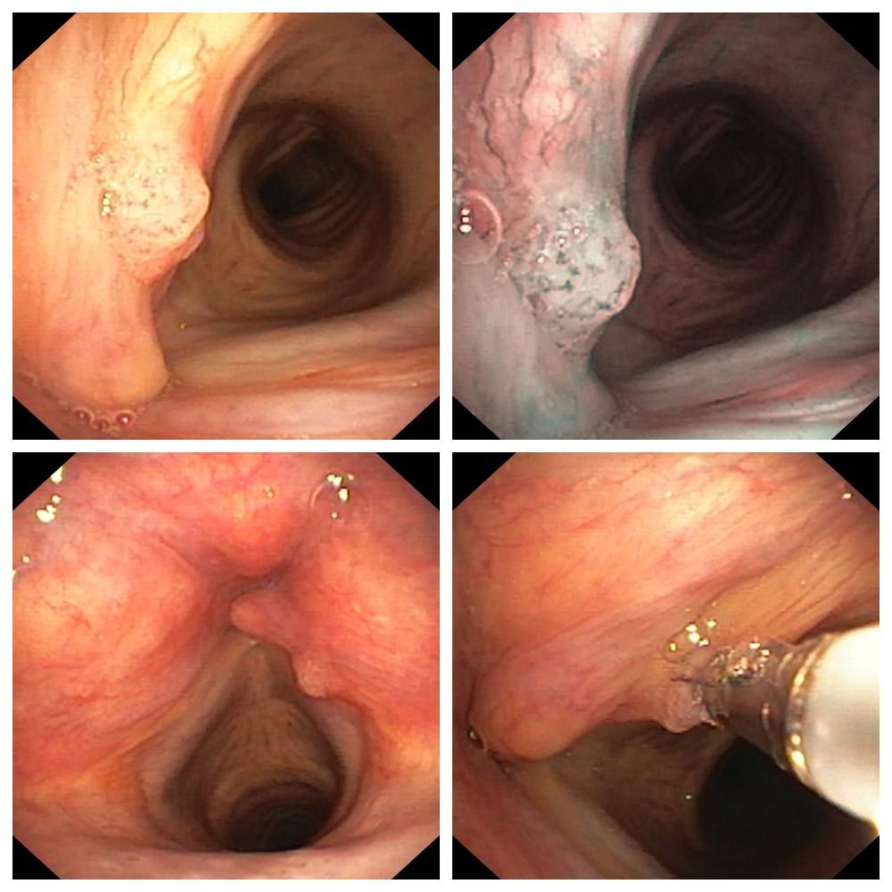 Плоскоклеточная папиллома гортани.. Атлас эндоскопических изображений endoatlas