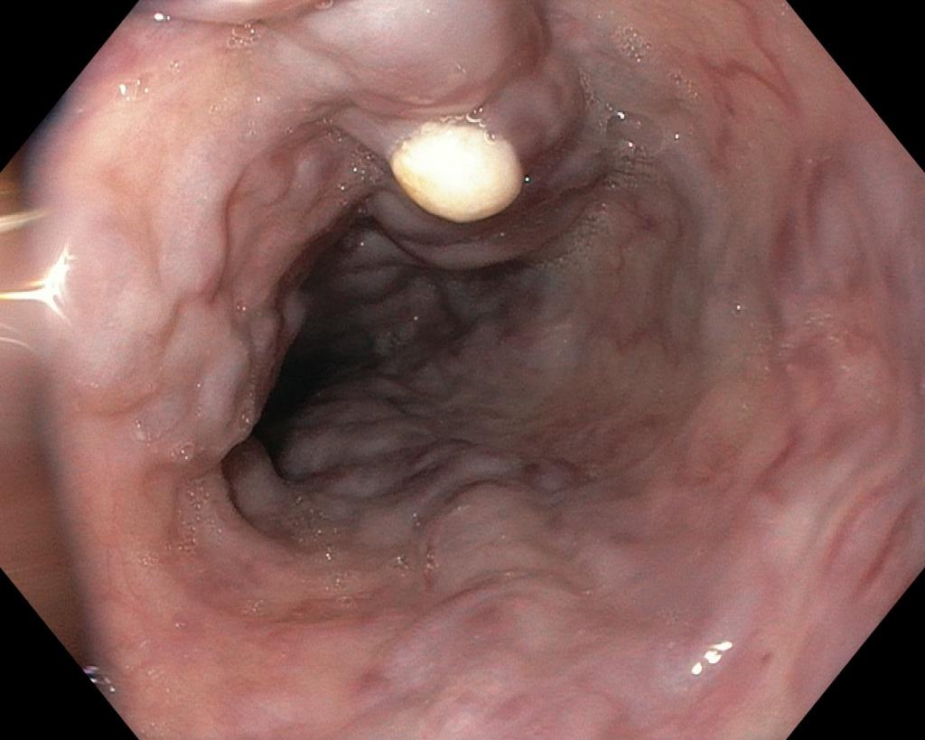Варикозно-расширенные вены пищевода 2-3 степени.. Атлас эндоскопических изображений endoatlas
