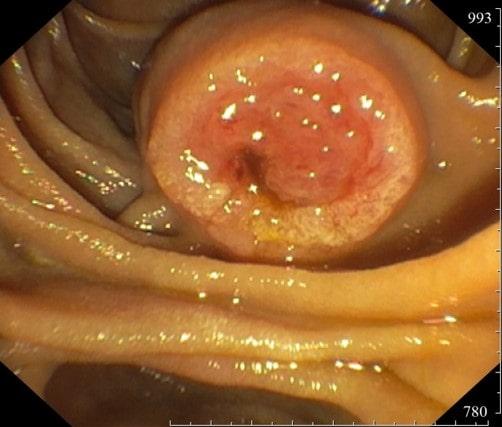 Рак БДС. Атлас эндоскопических изображений endoatlas