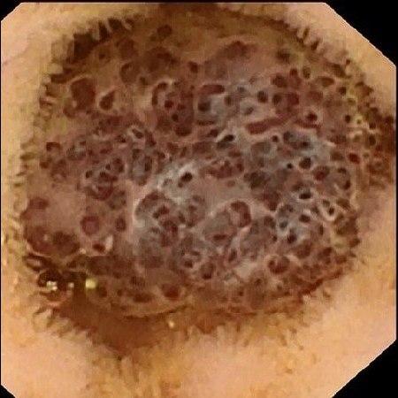 Кавернозная гемангиома тощей кишки. Атлас эндоскопических изображений endoatlas