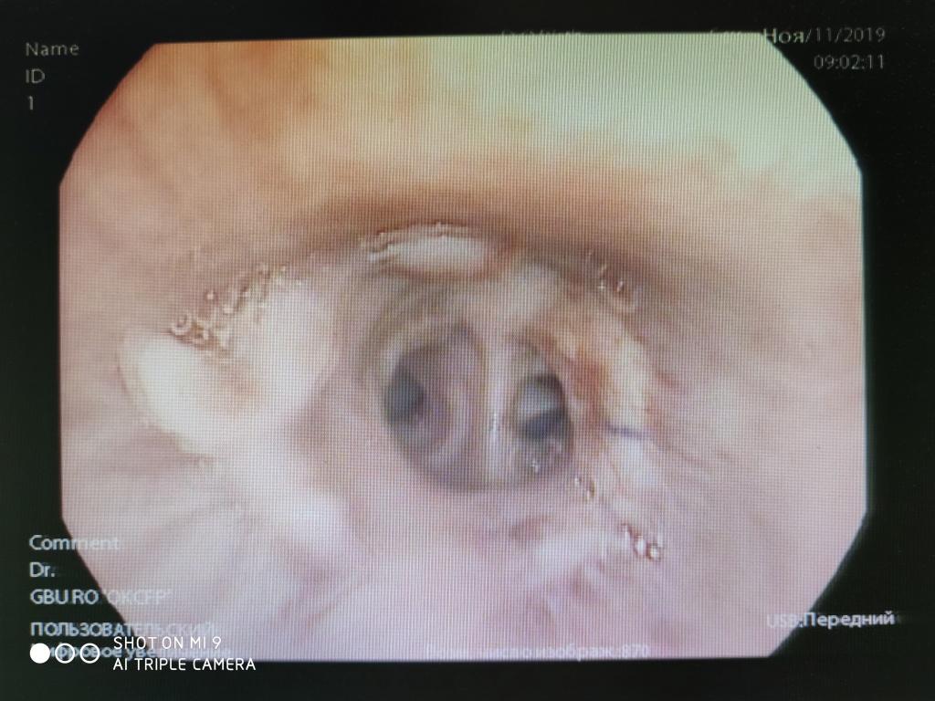 Анастомоз левые главный бронх-нижнедолевой бронх. Атлас эндоскопических изображений endoatlas