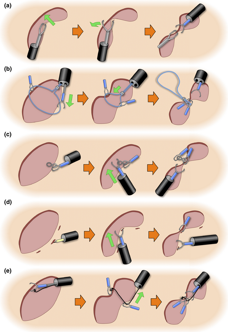 Эндоскопическая резекция слизистой оболочки. Эндоскопическая подслизистая резекция. Подслизистая диссекция. Эндоскопическая подслизистая резекция. Эндоскопическая резекция слизистой оболочки пищевода.