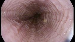 Эозинофильный эзофагит