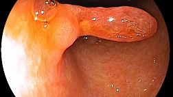 Гиперпластический полип желудка с интраэпителиальной неоплазией