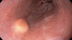 Эндоскопическая семиотика опухоли Абрикосова в пищеводе