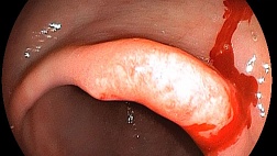 Ранний рак желудка