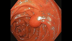 Диагностика и лечение липом  желудочно-кишечного тракта  (Практические рекомендации. Обзор литературы)