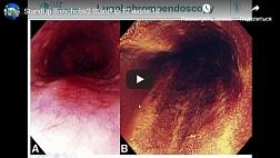 Опыт ведения пациентов в Европе с эрозивным поражениями пищевода и желудка: эндоскопическая диагностика и лечение Р. Бишопс