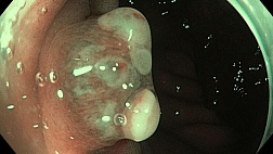 Гамартомный (ювенильный) полип прямой кишки
