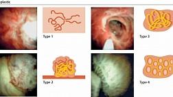 Классификации применяемые при пероральной холангиоскопии для диагностики поражений желчных протоков.  Роблес-Медранда 2018г.
