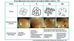 Классификация капиллярного рисунка (CP - capillary pattern) Y.Sano