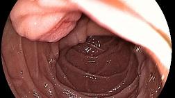 Аденома БДС