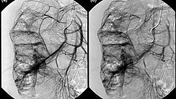 ПРИОБРЕТЕННЫЕ АНГИОДИСПЛАЗИИ ТОЛСТОЙ КИШКИ