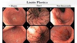 Клинический случай Пластический линит Linitis Plastica FB