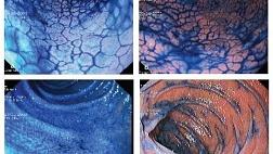 Эспумизан в гастроинтестинальной хромоэндоскопии