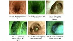 Эндоскопическая диагностика и лечение органического стеноза трахеи: методические рекомендации