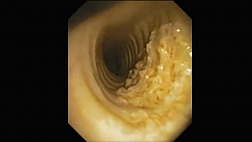 Хондроостеопластическая трахеобронхопатия