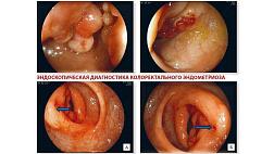 Эндоскопическая диагностика колоректального эндометриоза. Классификация эндометриоза по Матроницкому Р.Б 2012