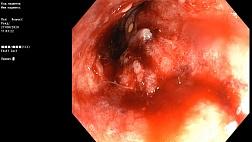 Стенозирующая опухоль сигмовидной кишки