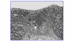 Ранний рак толстой кишки