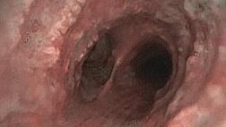 Остеохондропласти́ческая трахеобронхопати́я