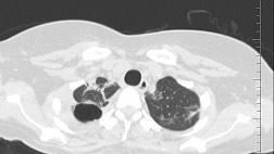 Клапанная бронхоблокация у пациентки с деструктивной пневмонией