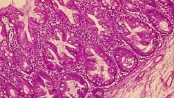 Роль эндоскопической биопсии в диагностике зубчатых образований толстой кишки