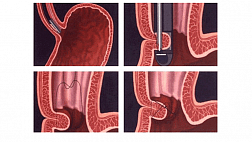 Новое в эндоскопии и колоноскопии (по материалам гастроэнтерологической недели 2004)