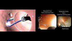 Качественные показатели для колоноскопии: современные идеи и предостережения. Ретроскоп. FUSE.