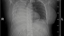 Применение эндоскопической клапанной бронхоблокации у пациентки 34 лет.
