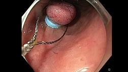 Удаление нейроэндокринной опухоли методом лигирования Rectal NET Band ligation EMR