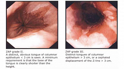 Z-линия пищевода. Классификация зубчатой линии ZAP.  Endoscopic assessment of the “Z-line” (squamocolumnar junction) appearance: reproducibility of the ZAP classification among endoscopists