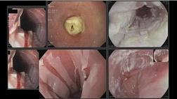 «Сползающий» отслаивающийся (эксфолиативный)эзофагит