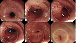 POEM 1000 cases 2016